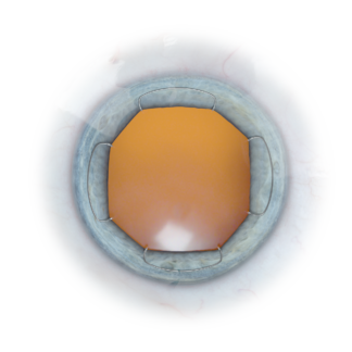 Image of the X1 Iris Speculum inserted in the eye to show pupil epxansion