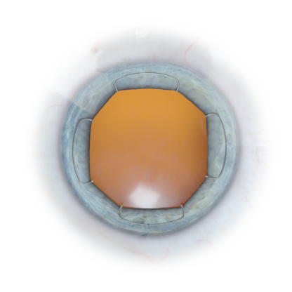 Image of the X1 Iris Speculum inserted in the eye to show pupil epxansion